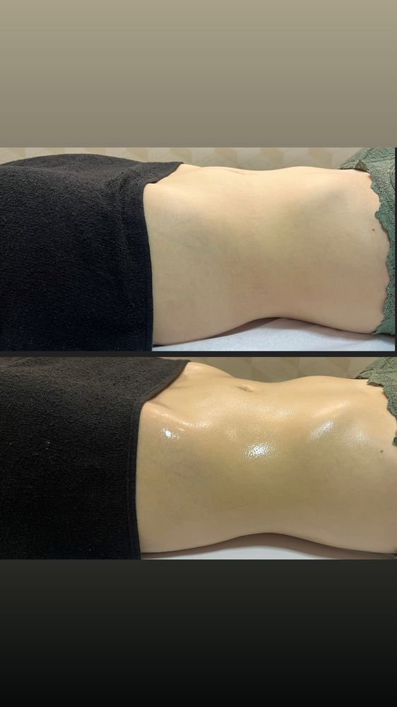 Antes e depois de drenagem linfática — Drenagem HD por Bia Aneli Estética (caso 4)