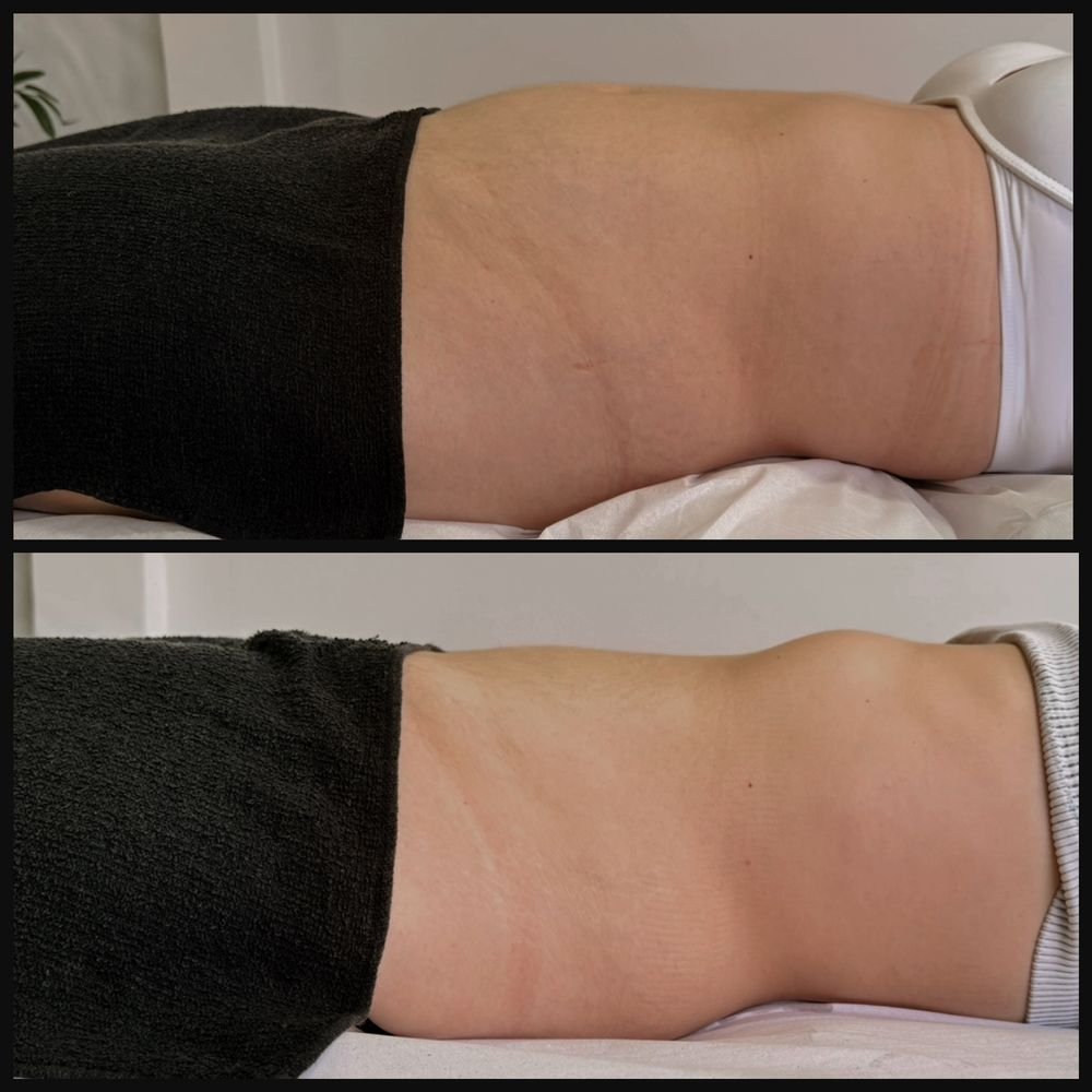 Antes e depois de drenagem linfática — Drenagem HD por Bia Aneli Estética (caso 6)