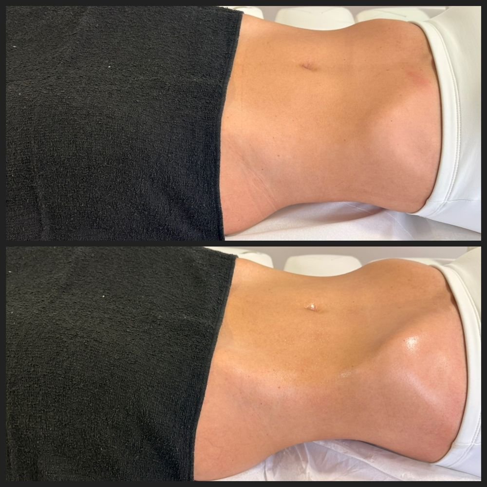 Antes e depois de drenagem linfática — Drenagem HD por Bia Aneli Estética (caso 8)