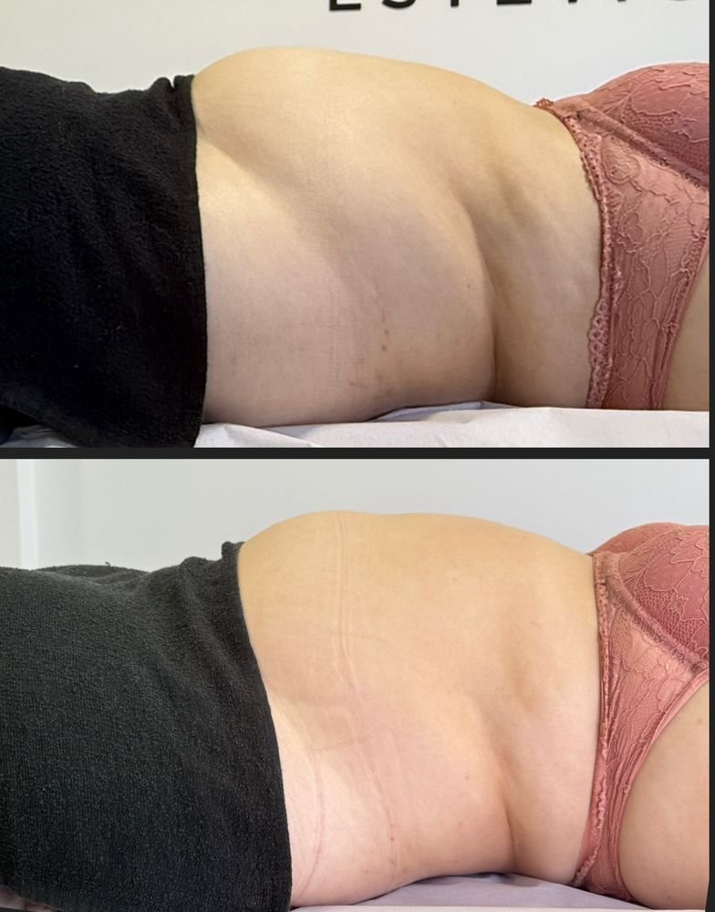 Antes e depois de drenagem linfática — Drenagem HD por Bia Aneli Estética (caso 13)